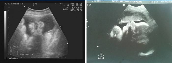 Ultrazvuk břicha ve 36 týdnech těhotenství