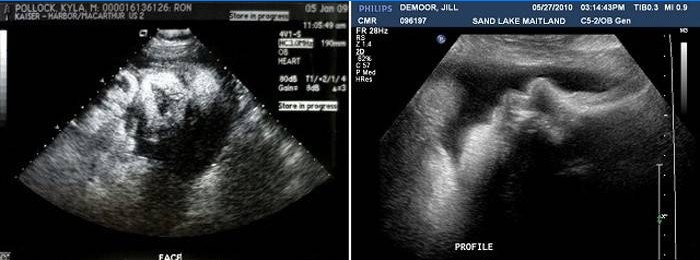 Ultrazvuk po 38 týdnech těhotenství