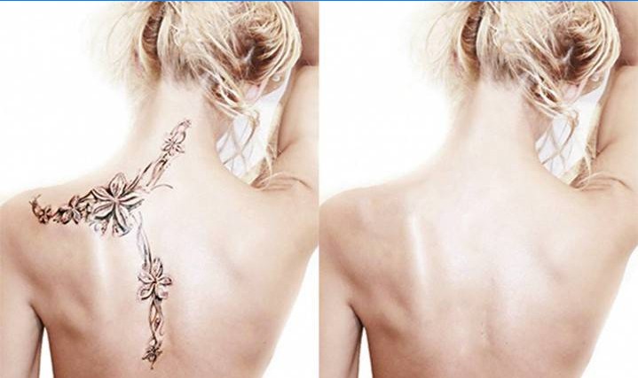 Dívka před a po odstranění tetování