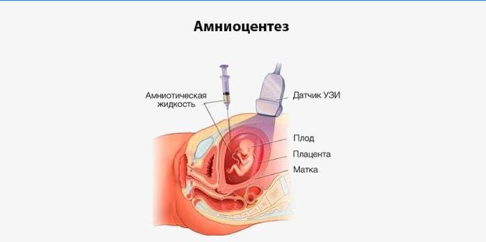 Amniocentéza na schématu