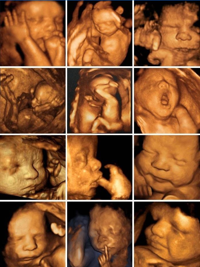 Fotografie plodu po trojrozměrném ultrazvuku