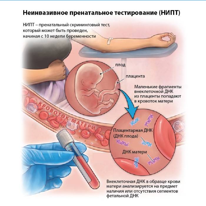 Neinvazivní prenatální testování (NIPT)