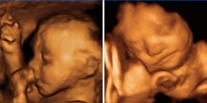 Ultrazvukové vyšetření chlapce a dívky ve 25 týdnech těhotenství
