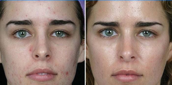 Kůže na dívčí tváři před a po mechanickém čištění kosmetologem