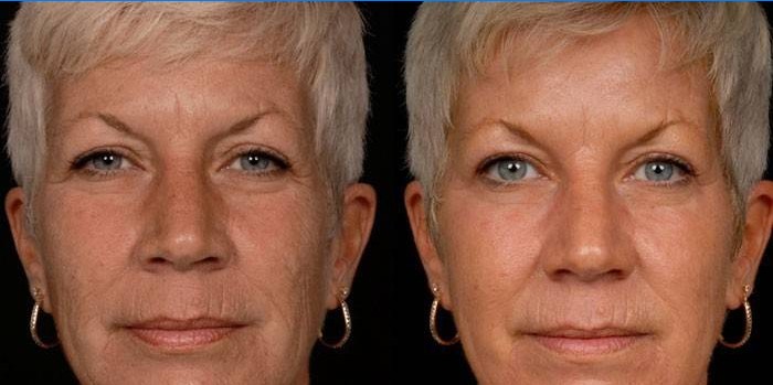 Fotografie ženy před a po karboxyterapii