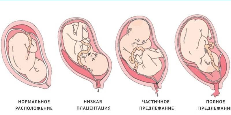 Druhy placenta previa