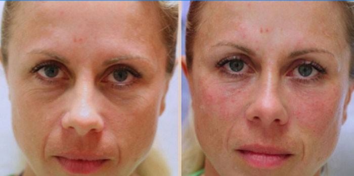 Ženská tvář před a po lipoliferaci