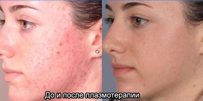 Kůže obličeje před a po plazmové terapii
