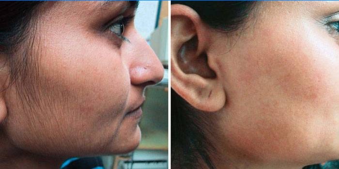 Laserové odstranění chloupků na obličeji: před a po fotografiích